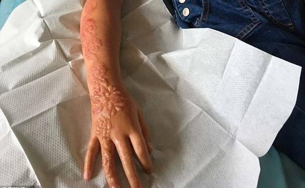 Un tatuaje de henna destroza el brazo a una niña de 7 años