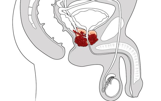 emprender un estudio sobre el cáncer de próstata