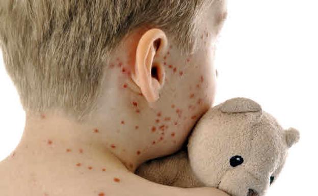 Los pediatras animan a seguir vacunando adolescentes ante los brotes de sarampión