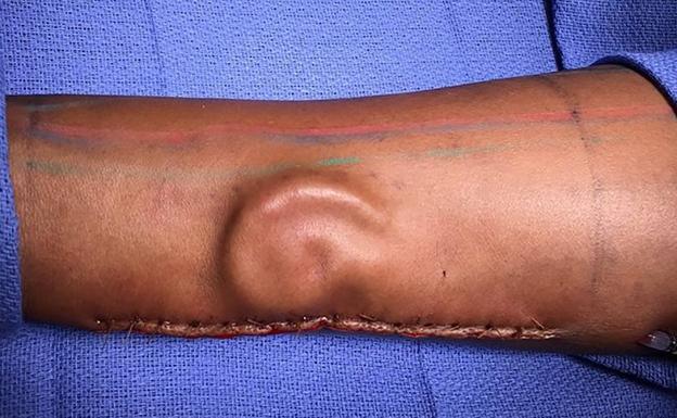 Volverá a tener oreja después de que los médicos la hayan hecho crecer en su brazo