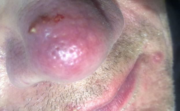 ¿Qué es la rosácea?