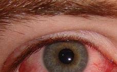 La conjuntivitis, otro posible síntoma del coronavirus