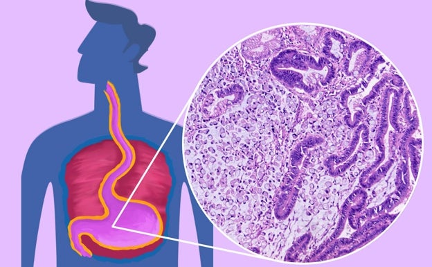 El instituto de investigación Incliva lanza una encuesta para evaluar el nivel de conocimiento sobre cáncer gástrico de los valencianos