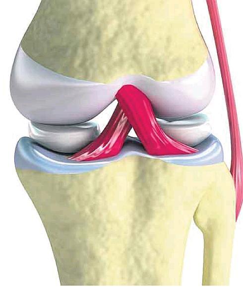 Microchips para evitar roturas de ligamentos