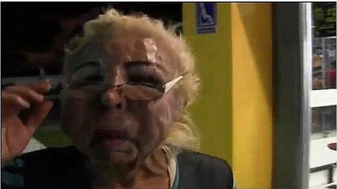 Se inyecta aceite de bebé en la cara y acaba con el rostro desfigurado