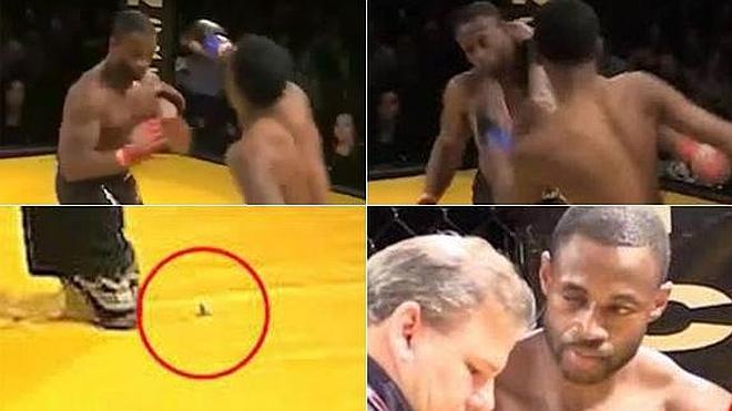 Un luchador de artes marciales pierde un ojo durante un combate