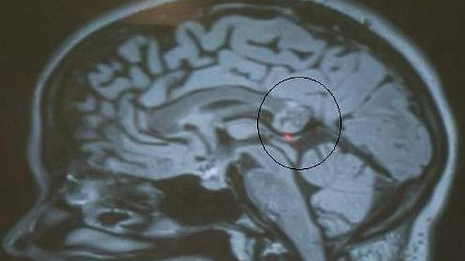Encuentran en el cerebro de una joven el embrión de su hermana gemela