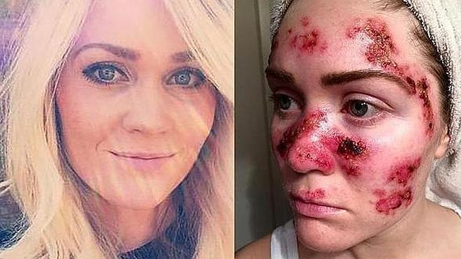 Publica en Facebook fotos de su cáncer de piel para alertar de los peligros de los rayos UVA
