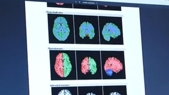 Desarrollan en Valencia un nuevo sistema de resonancias 'express' del cerebro