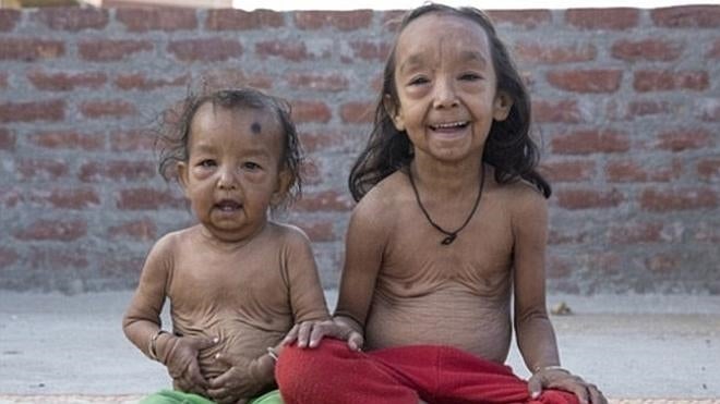 Una extraña enfermedad hace que dos niños parezcan ancianos