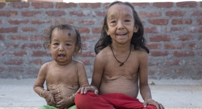 Una extraña enfermedad hace que dos niños parezcan ancianos