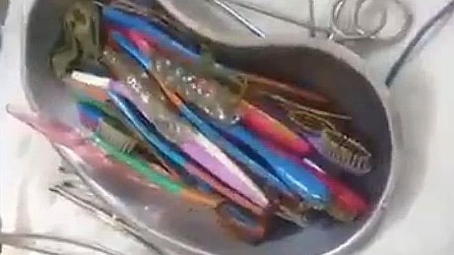 Extraen 18 cepillos de dientes del interior del estómago de un paciente