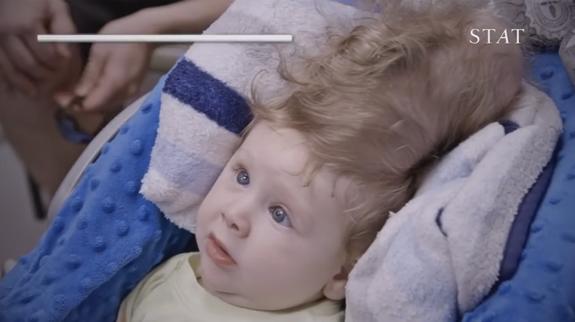 Sobrevive un bebé que nació con el cerebro fuera del cráneo