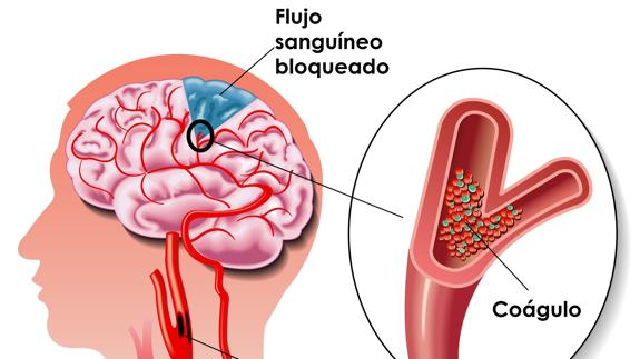 Cómo detectar y prevenir un ictus