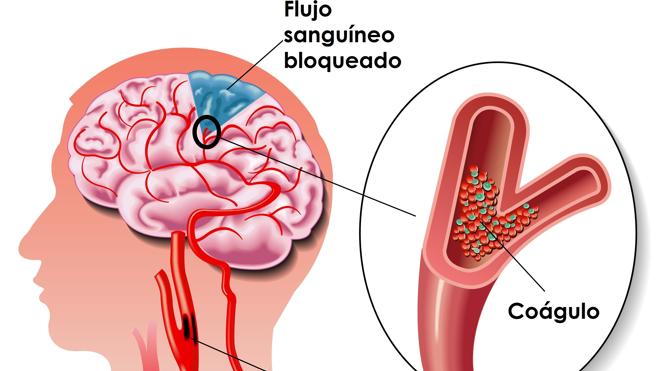 Cómo detectar y prevenir un ictus