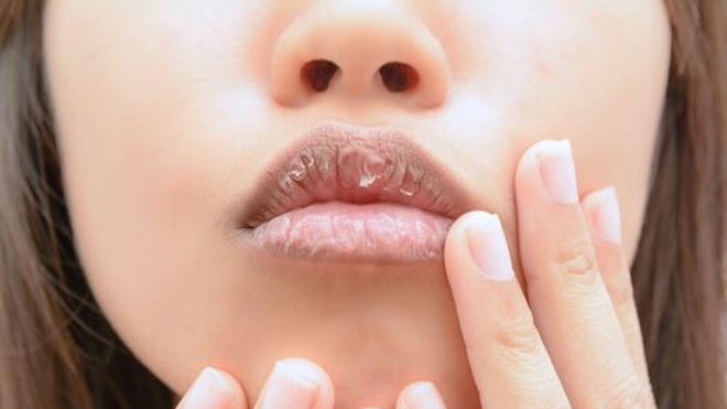 ¿Se te agrietan los labios? Aquí la solución