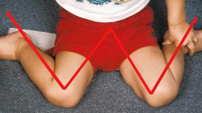Por qué los niños no deben sentarse con las piernas en 'W'