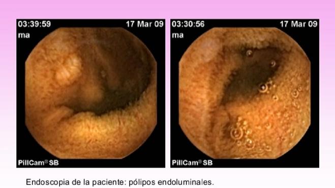 ¿Qué es el síndrome de Cowden, la enfermedad de Paco Sanz?