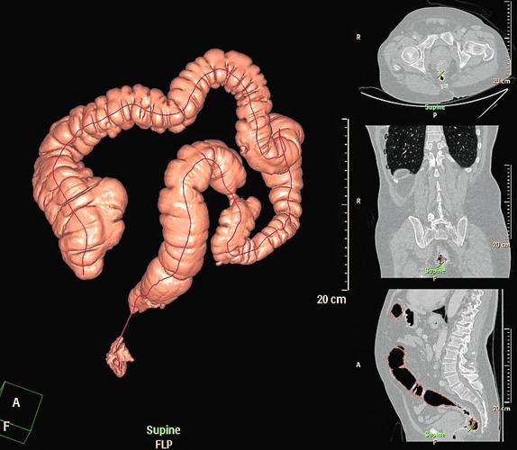 «Se deben hacer pruebas de colon a partir de los 50»